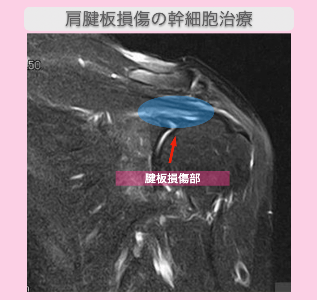 JMT日本干细胞案例-60多岁日本女性肩袖损伤的混合操作和干细胞治疗