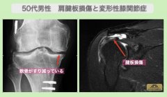  JMT日本干细胞案例-50多岁日本男性右肩袖损伤和右变形性膝关节症的干细胞治疗