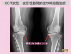 JMT日本干细胞案例-60多岁日本女性变形性膝关节症末期变形严重走路困难的干细胞治疗