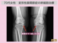 JMT日本干细胞案例-70多岁日本女性变形性膝关节症的干细胞治疗