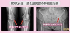 JMT日本干细胞案例-80多岁日本女性膝盖和股关节变形的干细胞治疗