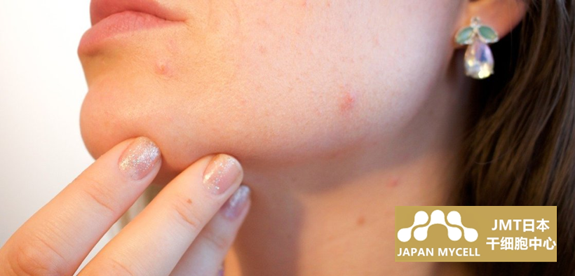 JMT日本干细胞中心-特应性皮炎是什么？解析干细胞治疗皮肤疾病