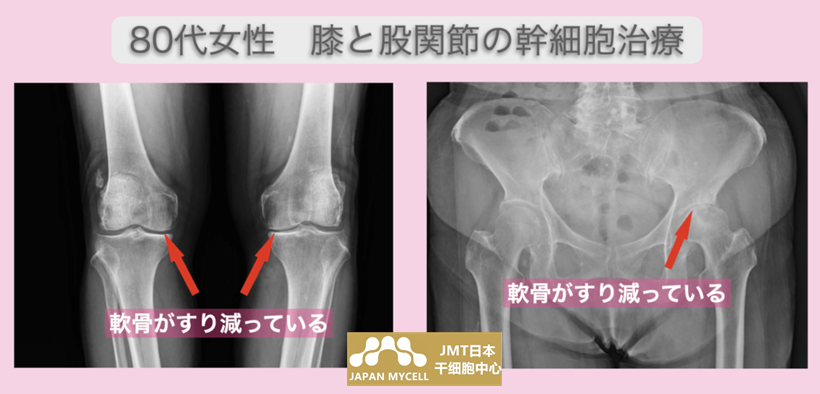 JMT日本干细胞案例-80多岁日本