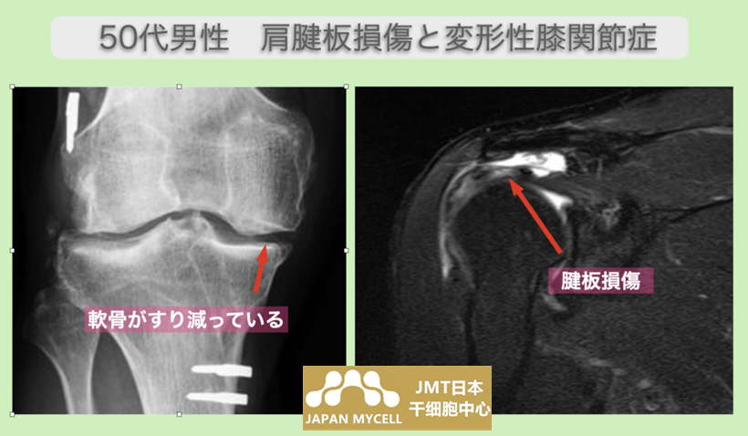 JMT日本干细胞案例-50多岁日本男性右肩袖损伤和右变形性膝关节症的干细胞治疗