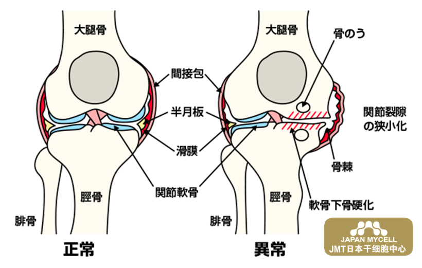 JMT日本干细胞治疗变形性膝关节-变形性膝关节病引起的疼痛