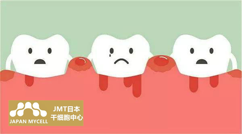 JMT日本干细胞中心干细胞治疗牙周病-关于牙周病的疑问解答③