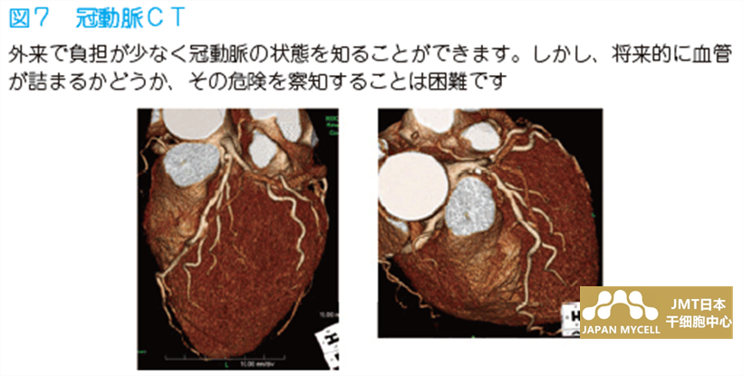 JMT日本干细胞中心-心梗的常见问题及干细胞治疗