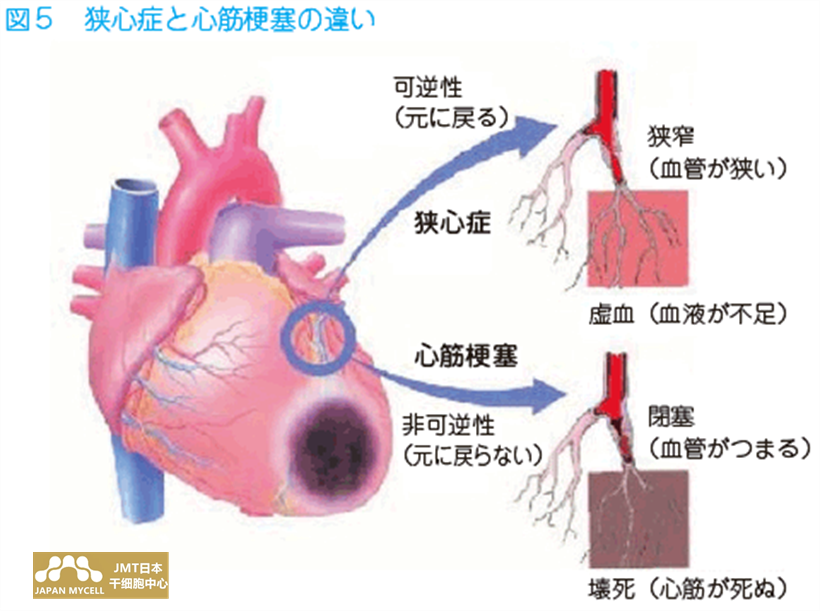 JMT日本干细胞中心-干细胞针对心肌梗塞的治疗