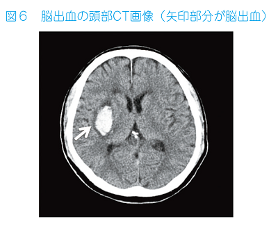 JMT日本干细胞中心-脑中风脑梗脑出血的及时救治及干细胞治疗