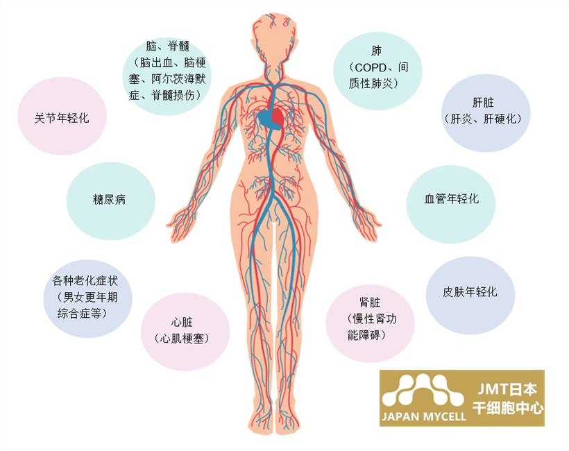 JMT日本干细胞中心-脑中风脑出血脑梗的预防复发及干细胞治疗