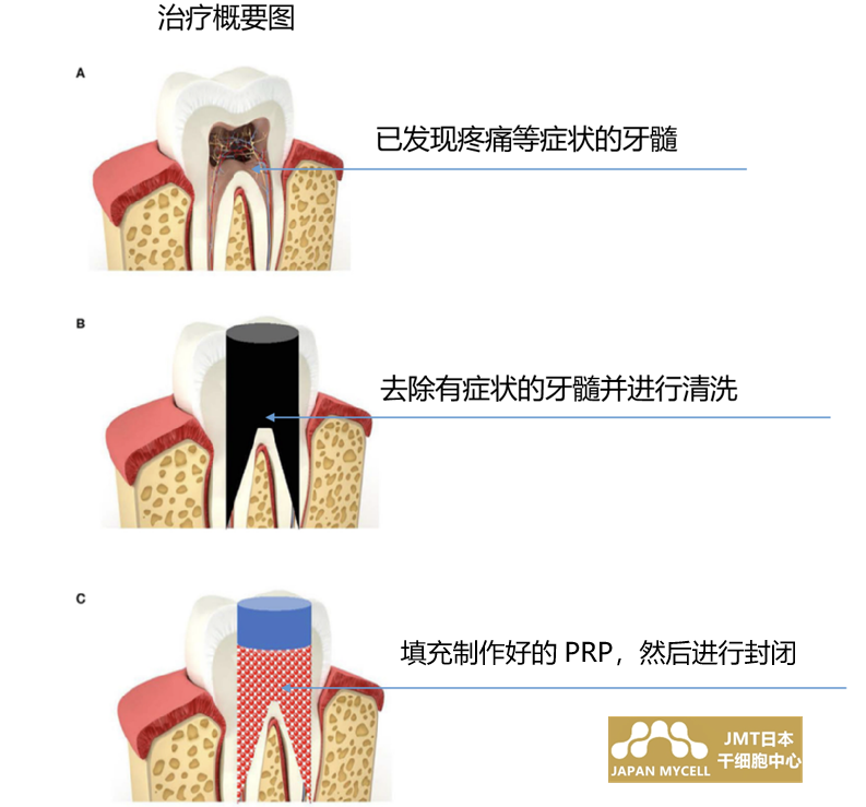 JMT日本干细胞中心-牙周炎干细胞治疗之利用富血小板血浆进行再生牙髓治疗