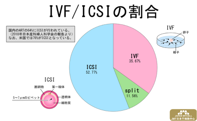 日本干细胞--显微授精（ICSI）治疗不孕不育有哪些优势和风险？