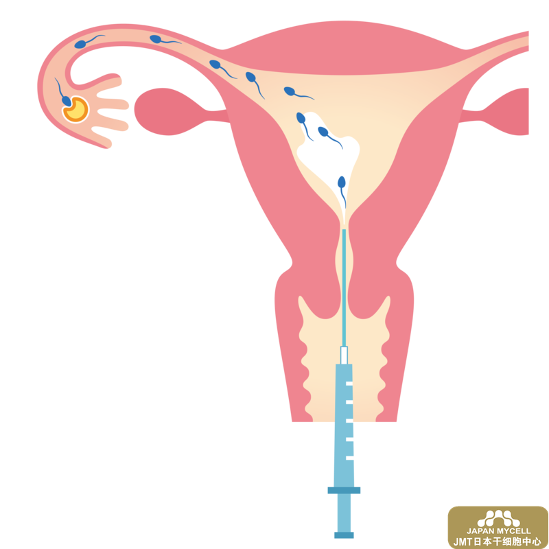 日本经血干细胞--不孕不育的治疗方法及其优缺点，日本经血干细胞治疗卵巢效果如何？
