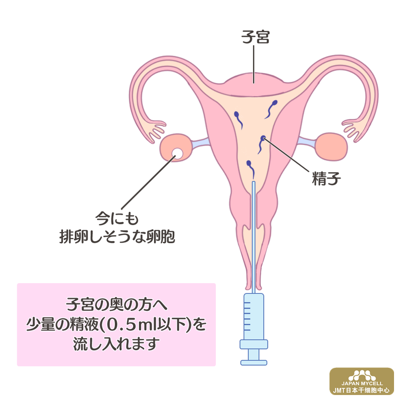 女性如何选择不孕不育的治疗方法-日本干细胞治疗的类型和方法