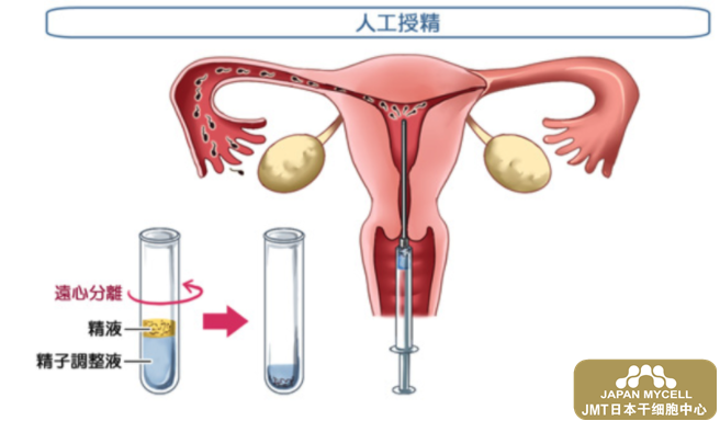 JMT日本干细胞中心-人工授精治疗不孕不育-日本干细胞有何帮助？