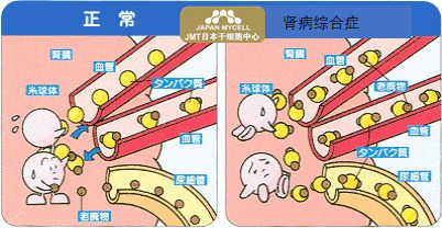 肝肾功能障碍之肾病综合症（NS）是什么-日本干细胞如何治疗