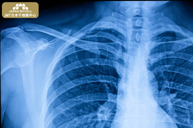 JMT日本干细胞中心-脊椎脊髓损伤后常见并发症之呼吸道感染、呼吸衰竭