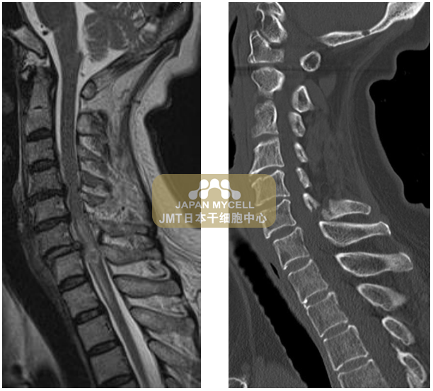 JMT日本干细胞中心-脊椎脊髓损伤后，再生医疗可期待修复受损部位