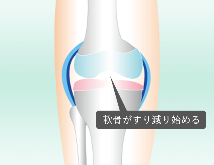 JMT日本干细胞中心-膝盖疼痛、膝关节变形症的再生医疗、干细胞治疗