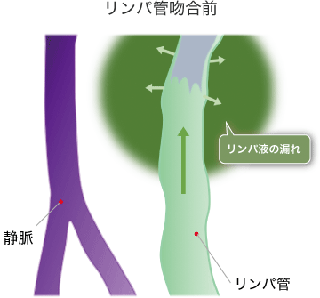 JMT日本干细胞中心介绍：淋巴水肿的再生医疗——症状与诊断详解